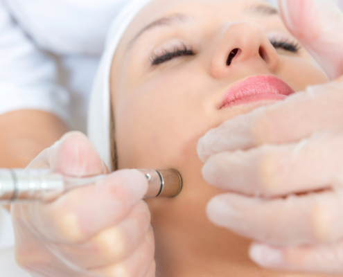 microdermabrasion