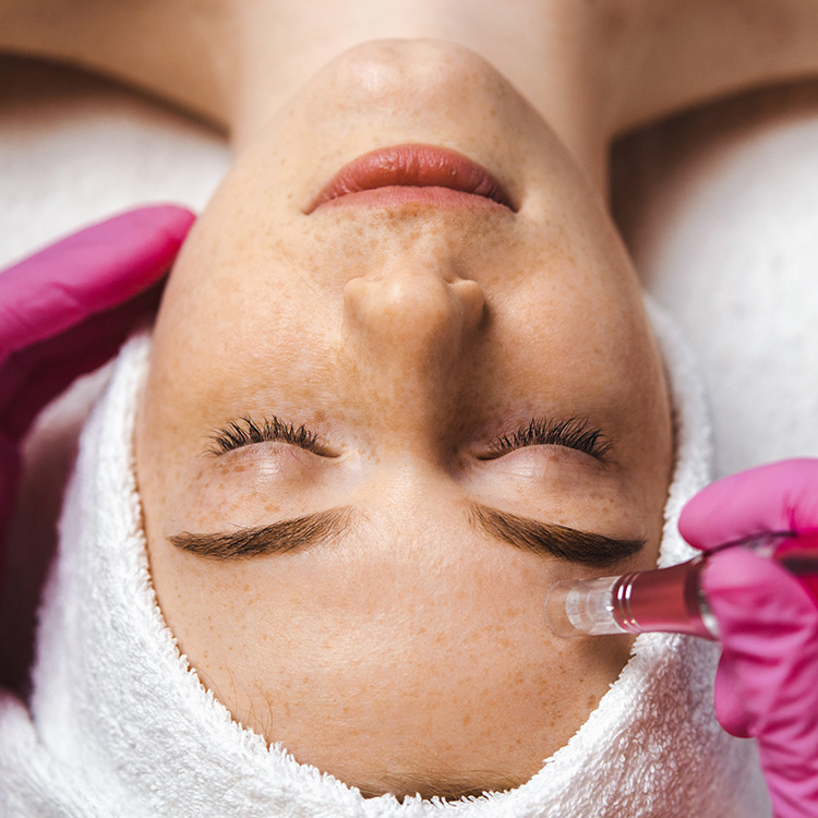 microdermabrasion